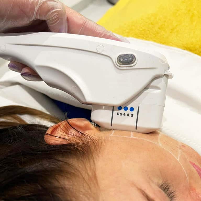 HIFU Non-Surgical Facelift